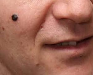 Read more about the article How to know about your moles and their significance?